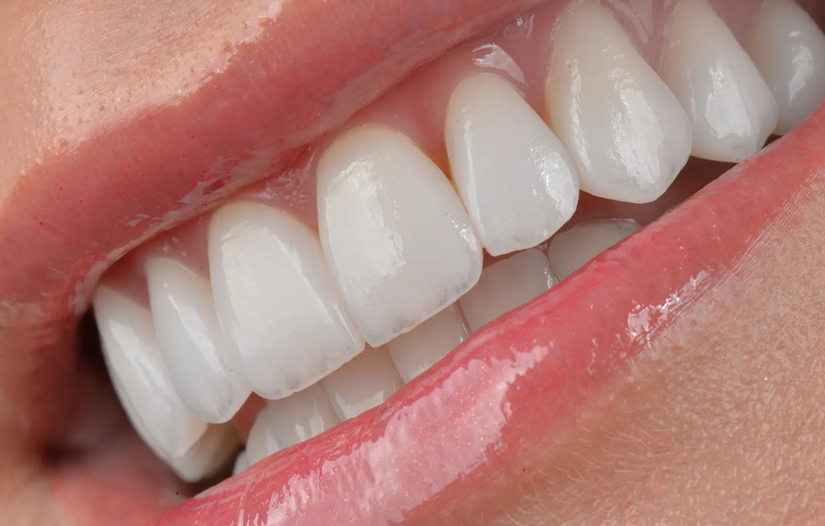tratamento-soep-Lente-de-contato-dental