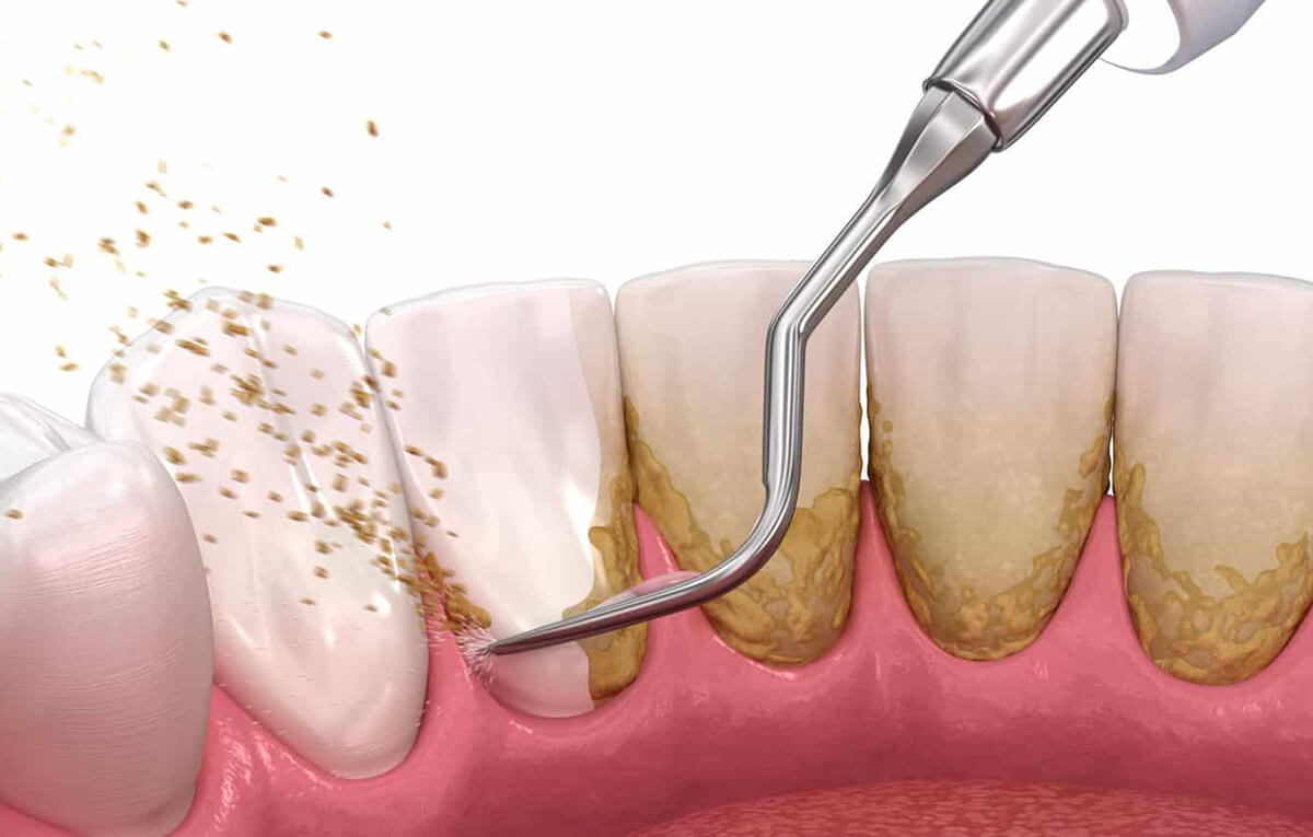 tratamento-soep-Limpeza-e-Raspagem