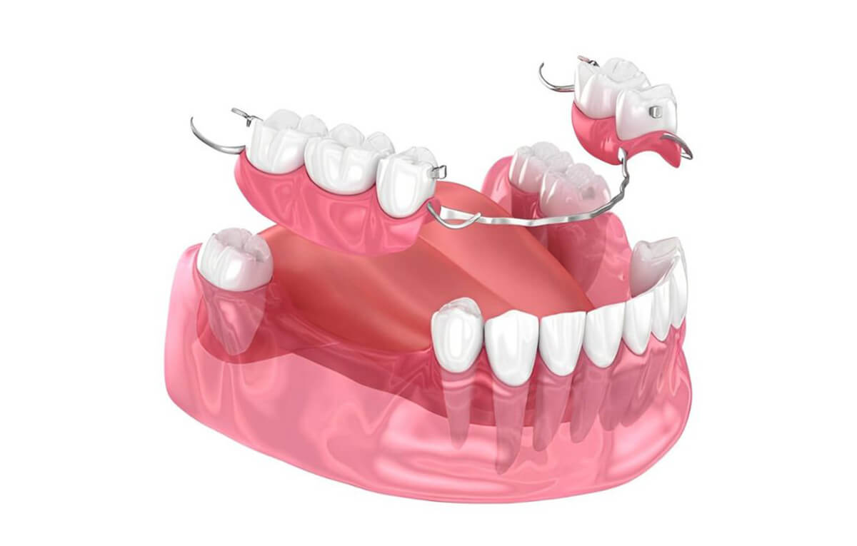 tratamento-soep-prótese-dentária