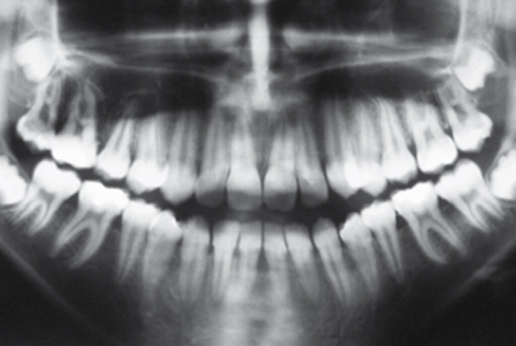 Efeitos-do-tratamento-em-duas-fases-da-Classe-III-no-paciente