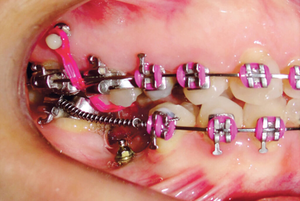 Efficiency of two protocols for maxillary molar intrusionwith mini-implants