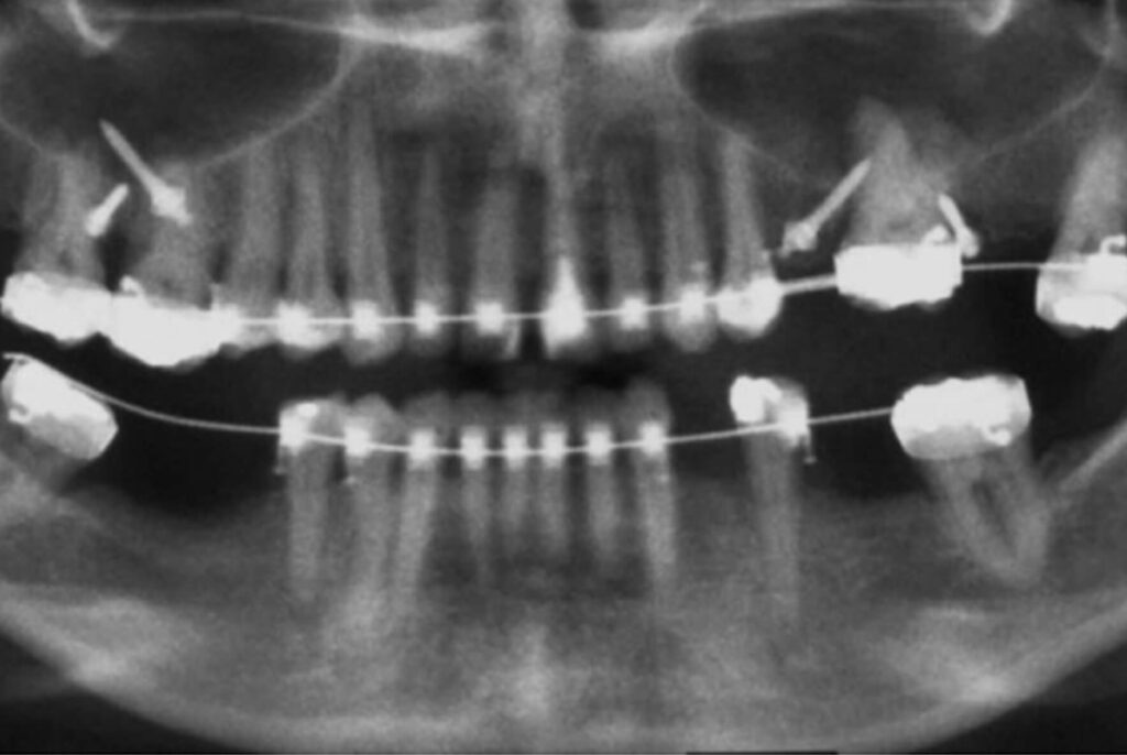 INTRUSÃO DE MOLARES SUPERIORES COM ANCORAGEM EM MINIIMPLANTES