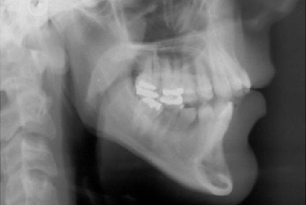 INTRUSÃO DE MOLARES SUPERIORES PARACORREÇÃO DA MORDIDA ABERTA ANTERIORESQUELÉTICA